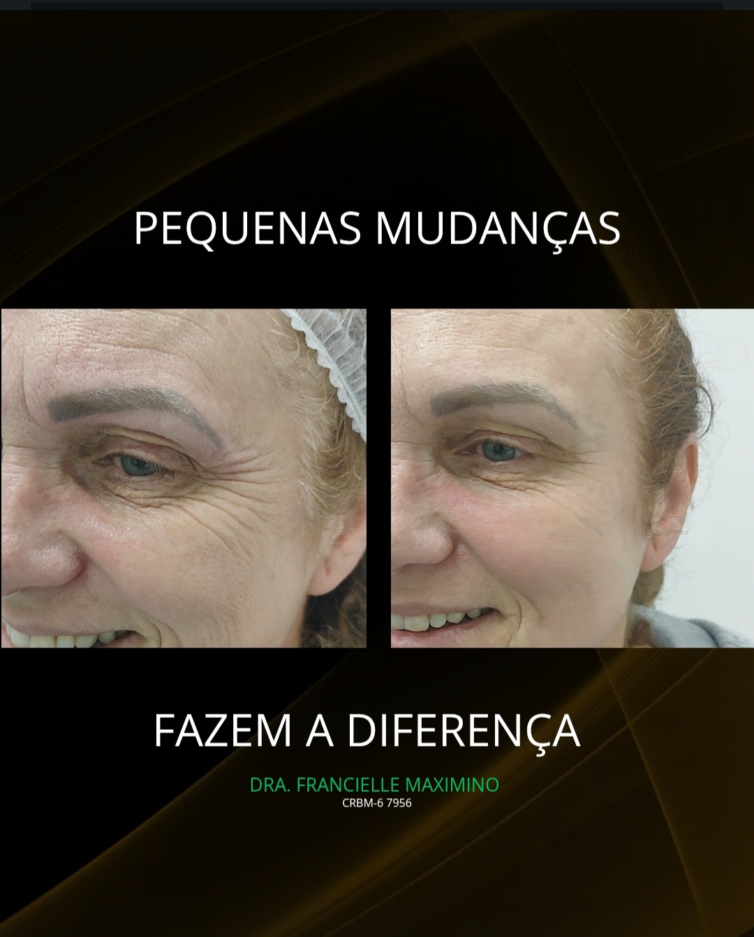 Bioestimulador de Colágeno