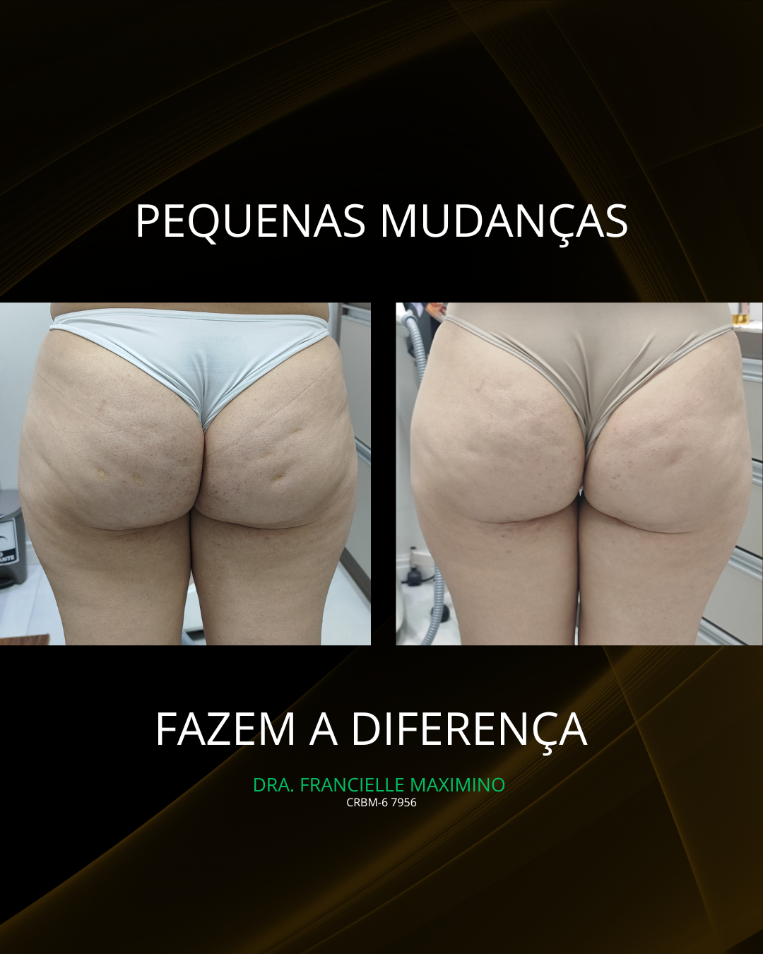 Tratamento Glúteos